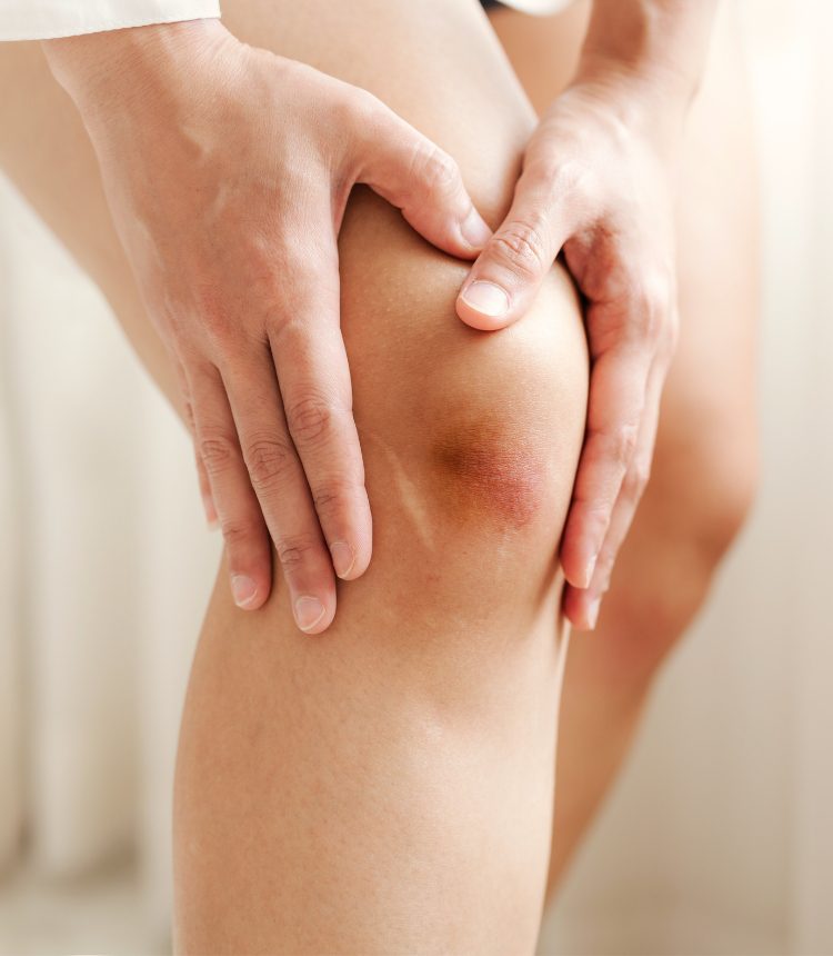 Drenaggio linfatico manuale: utile per favorire il recupero dopo contusioni, traumi o ematomi al ginocchio.